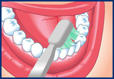 drawn-toothbrush-pressing-to-inside-of-bottom-teeth-to-get-into-gaps