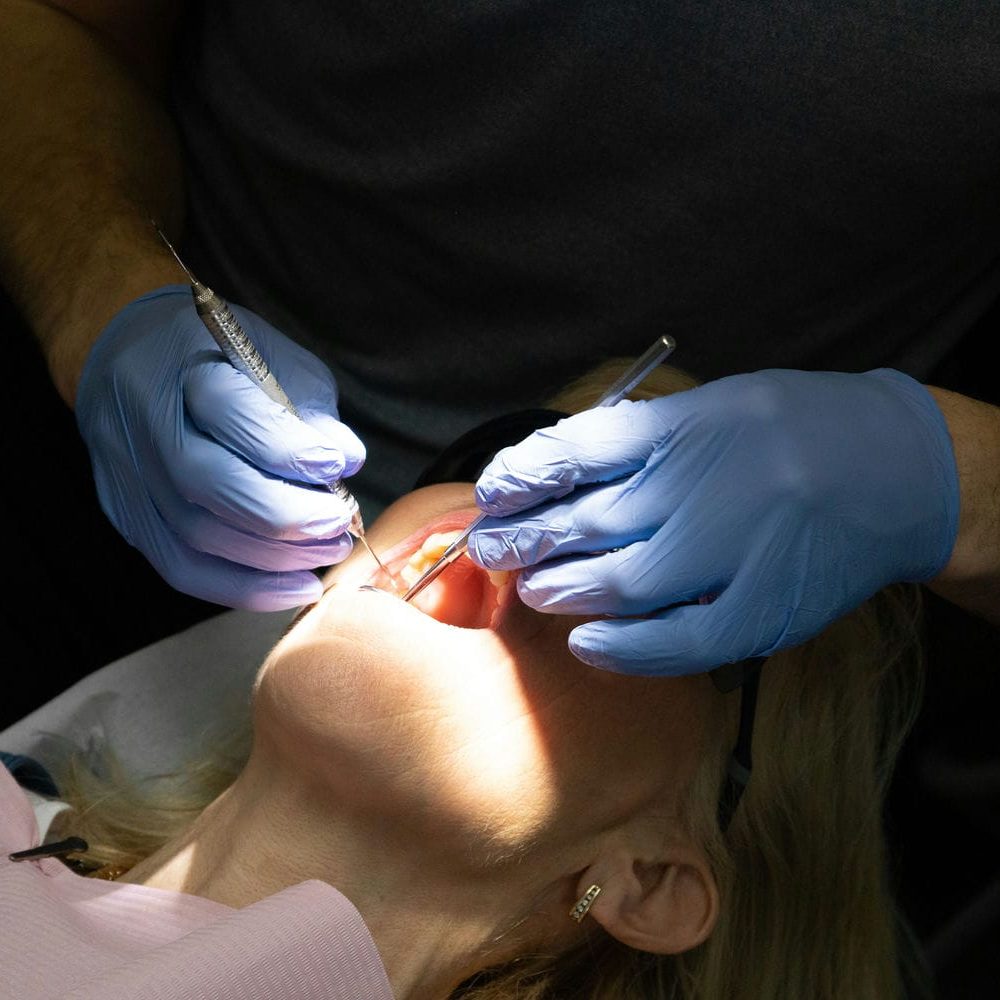 Close-up of a dentist shaping a front tooth with hand instruments during a dental bonding procedure